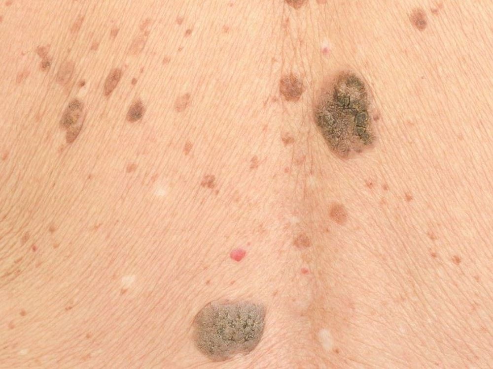 Keratosis seborrhoica széndioxid lézerrel történő eltávolítása