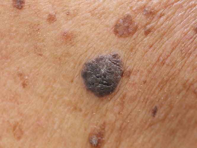 Keratosis seborrhoica széndioxid lézerrel történő eltávolítása