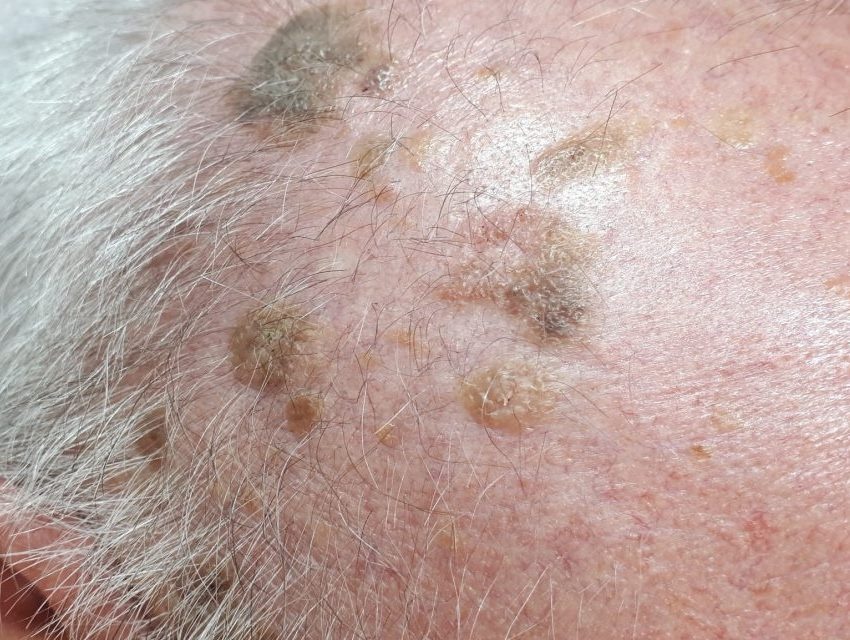 Keratosis seborrhoica széndioxid lézerrel történő eltávolítása