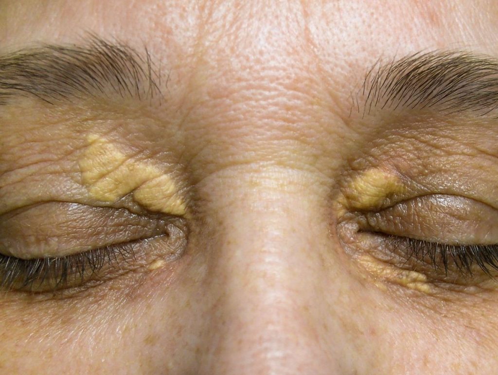 Xanthelasma palpebrarum széndioxid lézerrel történő eltávolítása