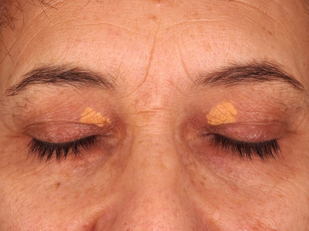 Xanthelasma palpebrarum széndioxid lézerrel történő eltávolítása