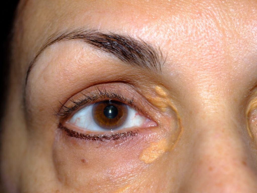 Xanthelasma palpebrarum széndioxid lézerrel történő eltávolítása